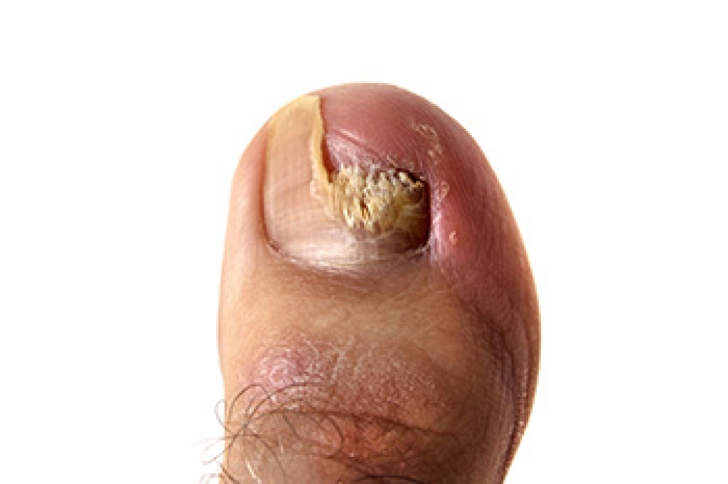 Common Symptoms of Toenail Fungus