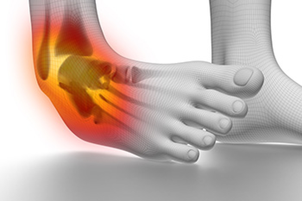 Chronic Ankle Instability and Repeated Sprains