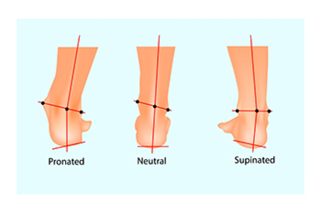 How Pronation and Supination Can Affect Foot Health