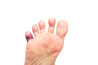 Fracture of the Pinky Toe