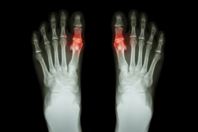 A Guide to Diagnosing Gout