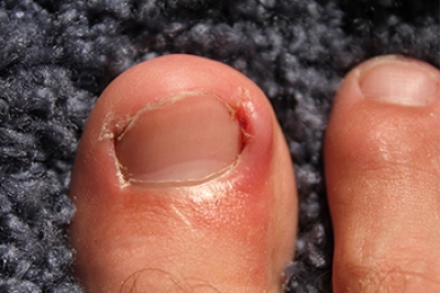 Understanding Ingrown Toenails