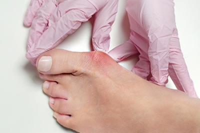 Understanding Bunions and Treatment Options