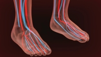 How Common Is Peripheral Artery Disease?