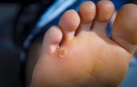 What Are the Treatments for Foot Corns?